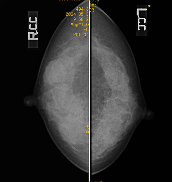 专科检查:右乳房外象限可扪及肿物直径约4cm,质中,边缘清,可活动.