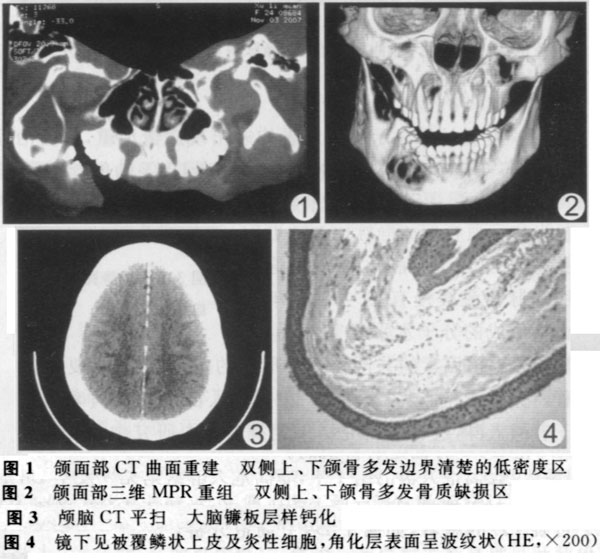 基底细胞痣综合征1例