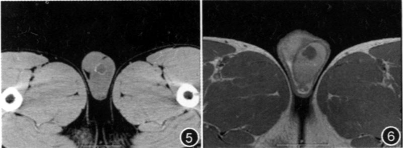 mri诊断睾丸表皮样囊肿二例
