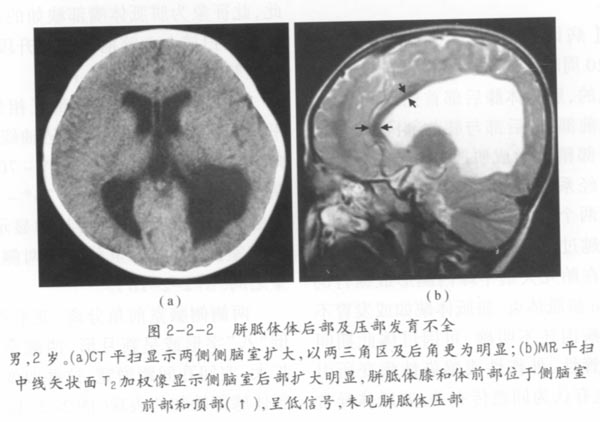 胼胝体体后部及压部发育不全01