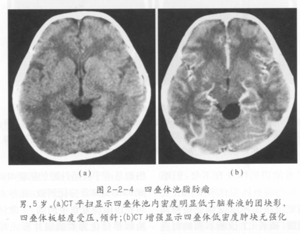 四叠体池脂肪瘤01