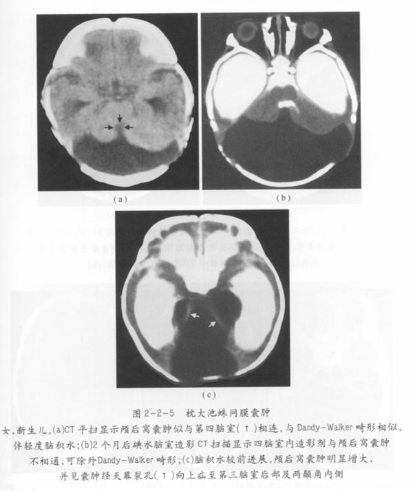 枕大池蛛网膜囊肿01